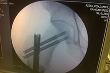 An x-ray of Ken Riess's leg, post operation.